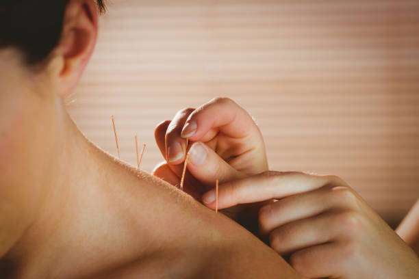 Acupuncture Therapy Image